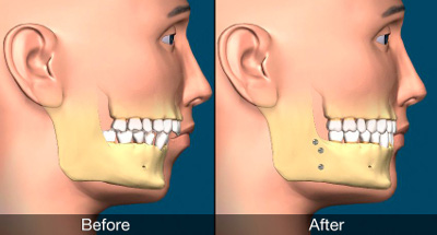 Orthognathic Surgery: is always necessary? | Dental Wellness Group