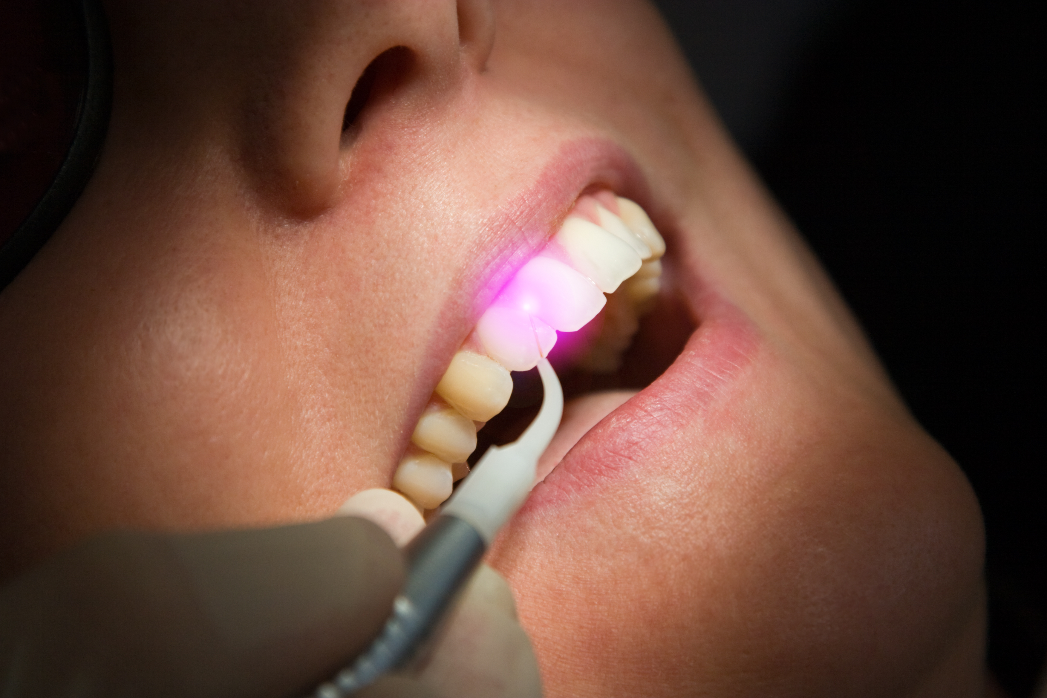 laser dentistry and laser gum treatment